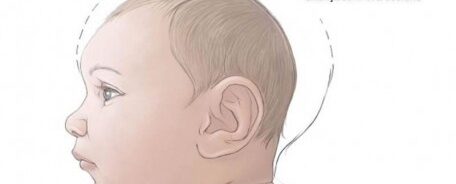 Criança com Microcefalia