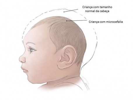 Criança com Microcefalia